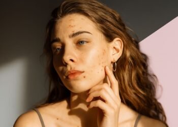 8 Home Remedies For Acne