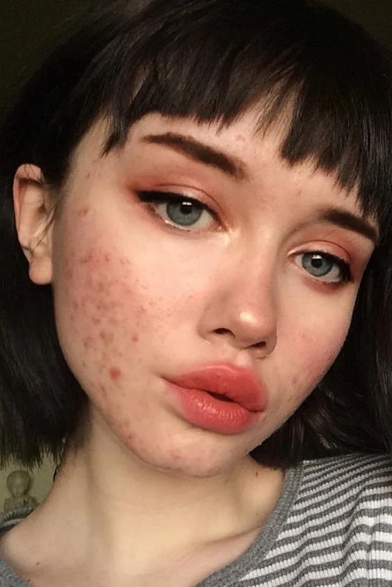 What Is Acne