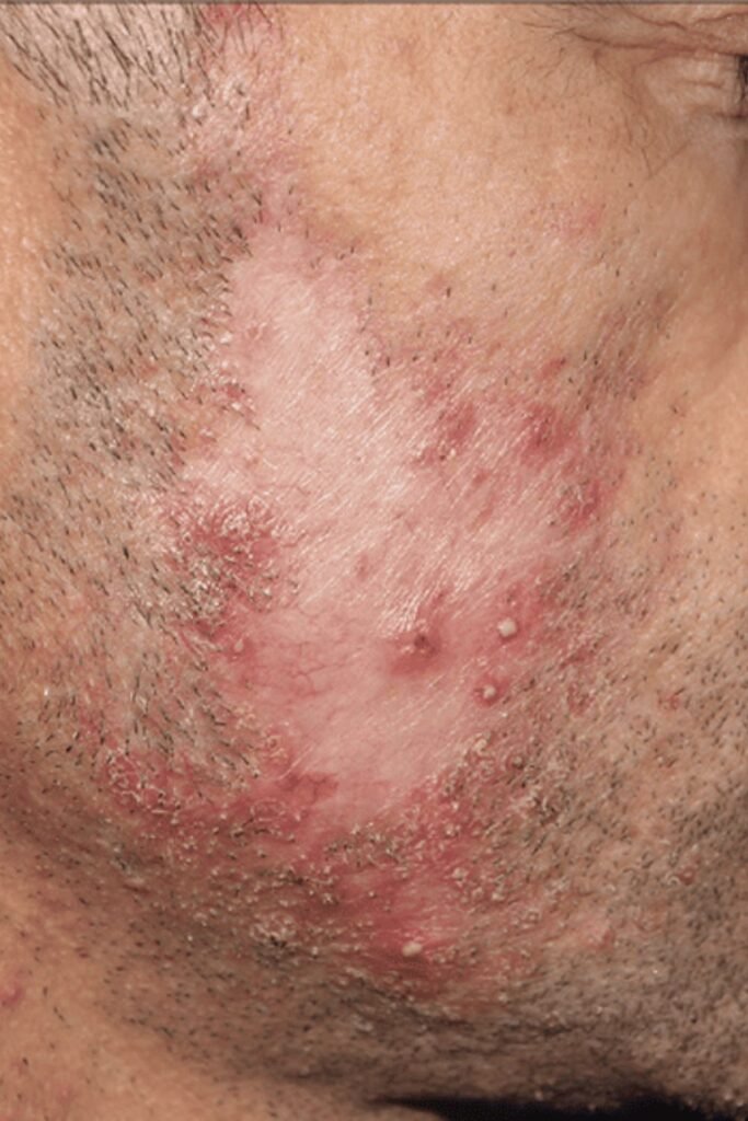 Bacterial Buildup and Poor Hygiene